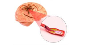 Aneurisma cerebrale: cos’è, come si manifesta e quali sono i rischi
