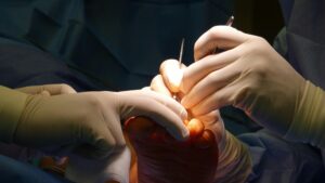 Alluce valgo operato e in piedi in pochi giorni: cosa è cambiato nella cura di questa patologia