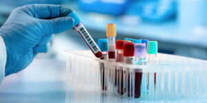 Alzheimer, rivoluzione nella diagnosi: un semplice test del sangue per misurarne la gravità
