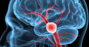 Aneurisma cerebrale: i segnali che possono comparire prima della rottura