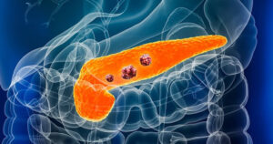 Al via la prima sperimentazione clinica al mondo per un trattamento sperimentale del cancro al pancreas