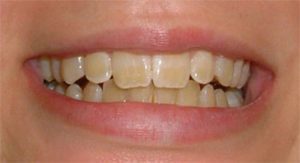 Denti non più bianchi? 8 motivi per cui succede