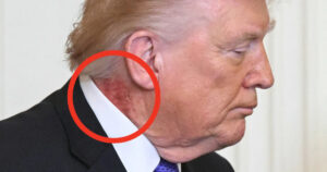 Il presidente più anziano degli Stati Uniti: quali malattie ha Trump e cosa ci dicono quei lividi ricorrenti
